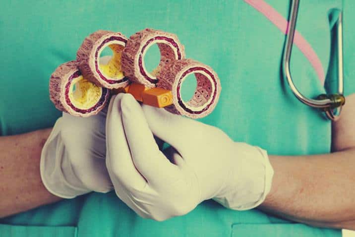 Cómo mejorar la mala circulación de la sangre 2 arterosclerosis